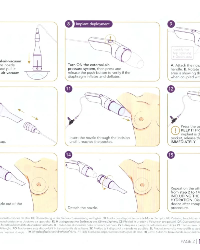 Motiva Injector MIA — sayfa 2: implant deployment ve yerleştirme adımları